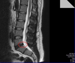 2014 грыжа межпозвоночная
