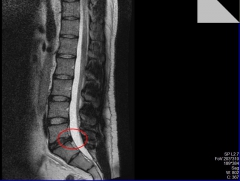 2011 грыжа межпозвоночная
