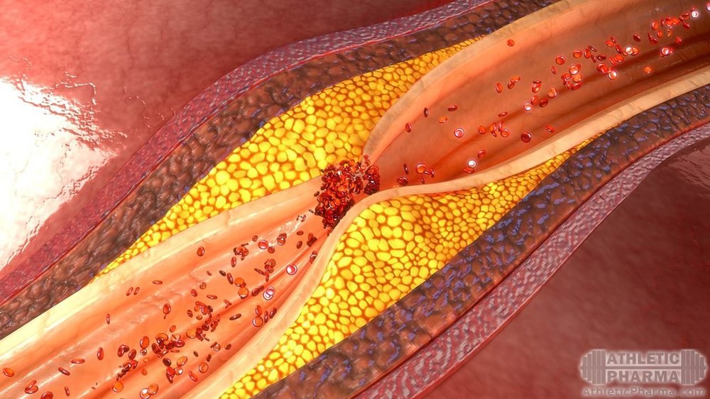Закупорка сосудов