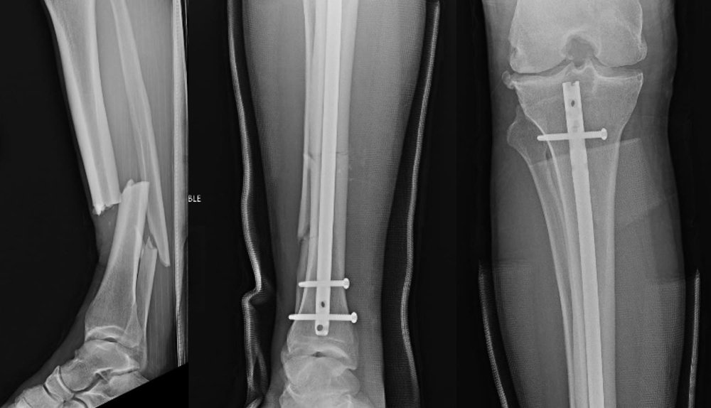 Перелом Криса Вайдмэна