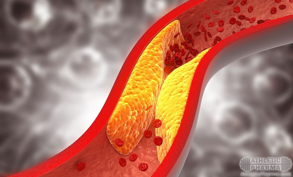 Тромб (холестерин) в сосудах